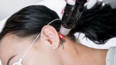 O laser emite pulsos ultra rápidos que a tinta da tatuagem absorve, fragmentando-se em partículas minúsculas (Foto: Getty Images)